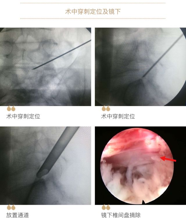 腰椎间盘突出症治疗之椎间孔镜脊柱微创技术