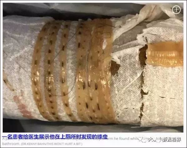 恐怖男子脑内藏囊虫这样做饭的人小心了