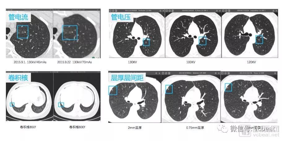 肺结节检出(图片来源于深睿医疗)