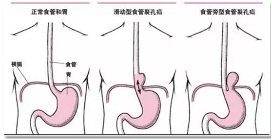 中老年人饭后常烧心,反酸,别只当胃病掉以轻心