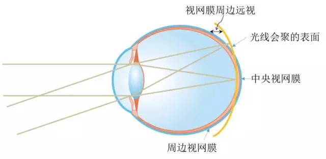 塑形镜的原理_△角膜塑形镜视力矫正原理(2)