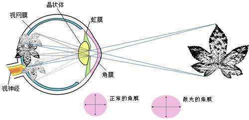 如果眼球在不同的经线上的屈光状态或屈光度不一致,尤其是角膜表面的