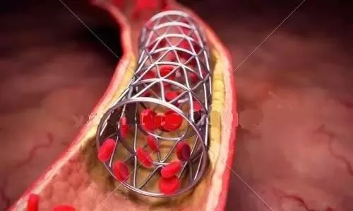 冠状动脉支架手术的几大误区不知道坑了多少人