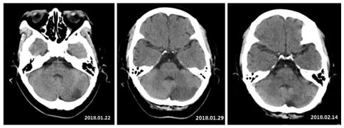 良性小脑大面积梗死1例