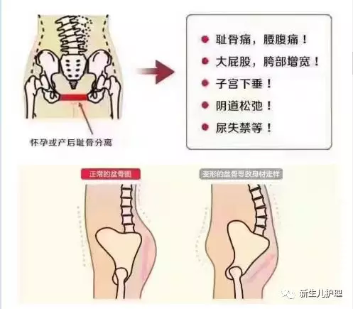 产后越来越胖如何快速产后修复原来骨盆聚合才是关键