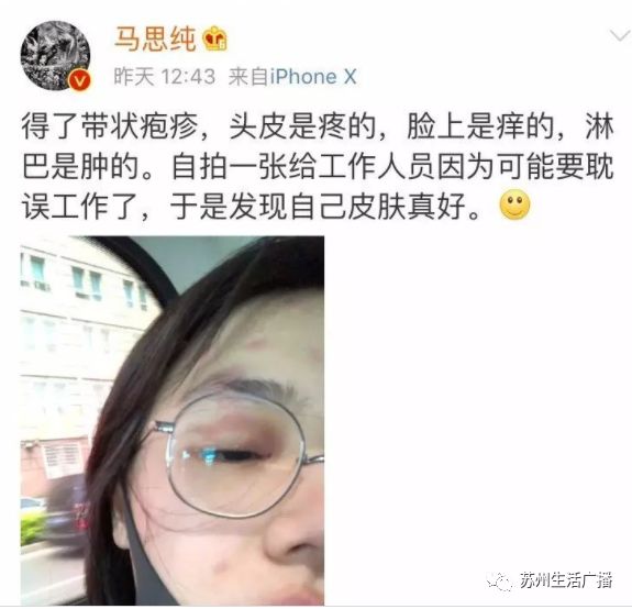 什么是带状疱疹?