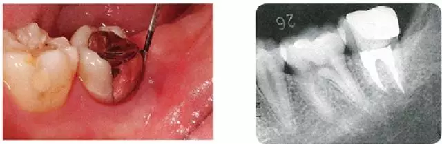 智齿拔牙2个月后的状态,由于拔牙是的左下7的远中牙槽骨大量缺损.