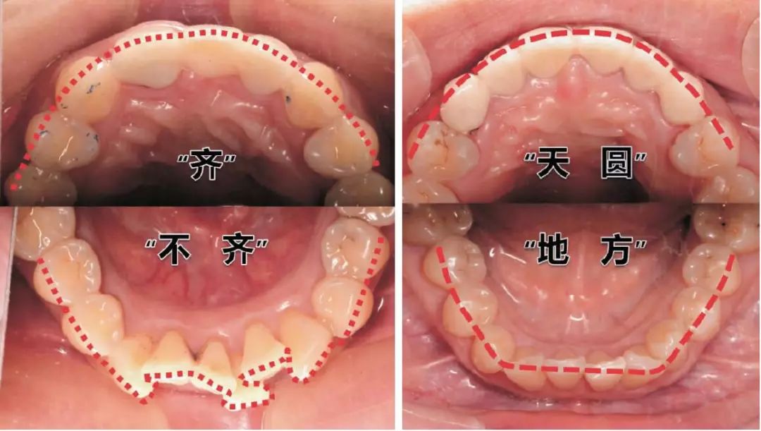 下颌牙列排列不齐     上下牙弓排列曲线不同