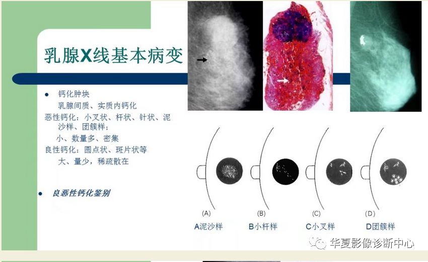 乳腺x线基本表现附有病理及简图对照