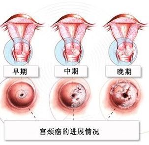 术前子宫动脉栓塞可防止大出血 4,宫颈癌 常见女性生殖系统肿瘤