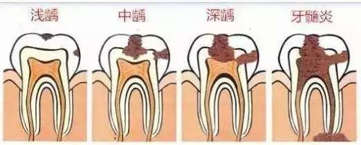 海南口腔医院:当心"腹黑"龋齿 牙齿有个小洞也要补