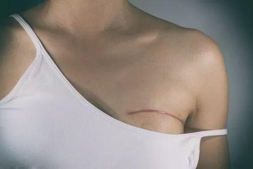 乳腺癌手术,是不是一定要切除整个乳房?