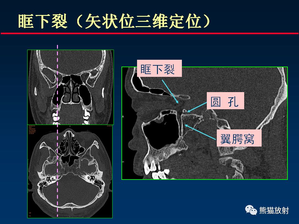 颅底重要ct解剖及其临床意义