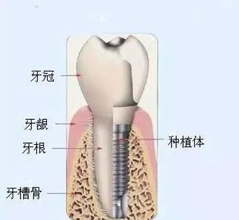 医生,我想做种植牙,但是牙槽骨很薄,怎么办?