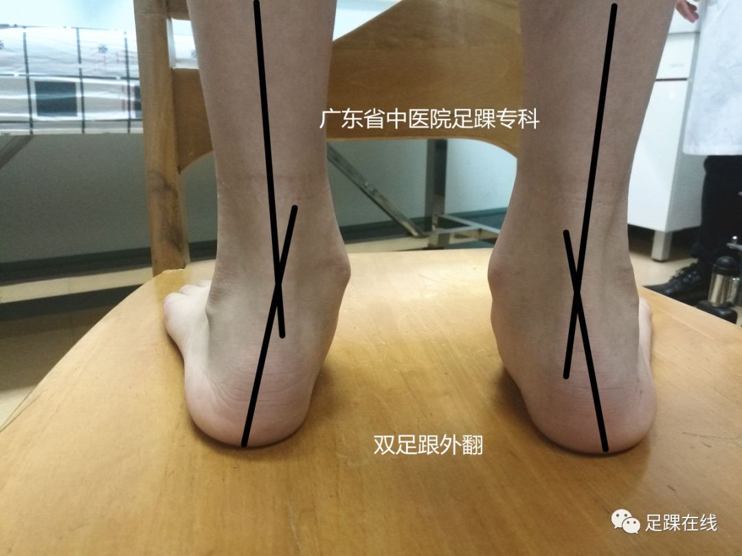 儿童“O”型腿及“X”型腿：了解儿童膝内翻与膝外翻 (原创)_下肢