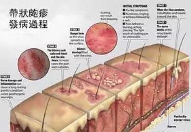 马思纯得了带状疱疹还这么调皮,小心疼起来要撞墙