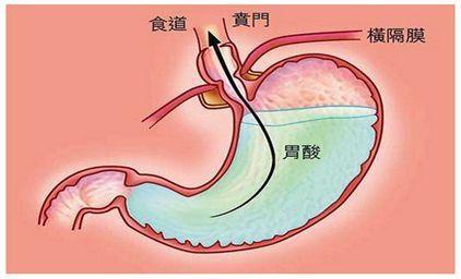 经常胃酸怎么办