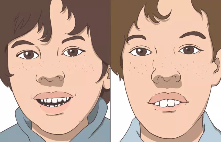 孩子出现牙齿排列不齐,上切牙凸出,厚嘴唇,这就是"腺样体面容"