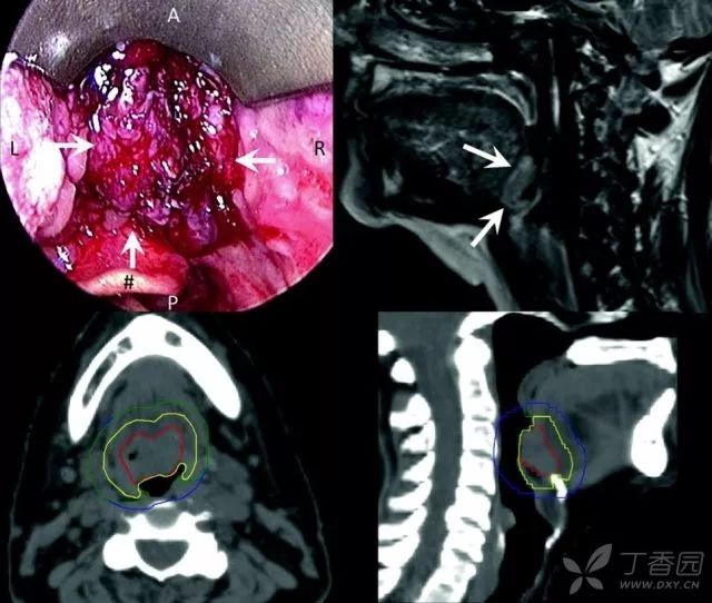 喉,下咽,口咽和口腔原发肿瘤临床靶区 (ctv-p) 勾画共识