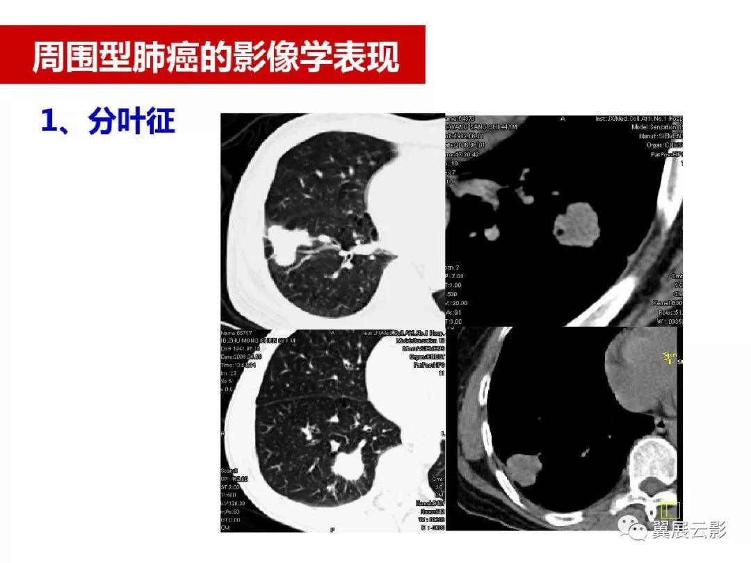 【收藏】肺癌影像表现综述