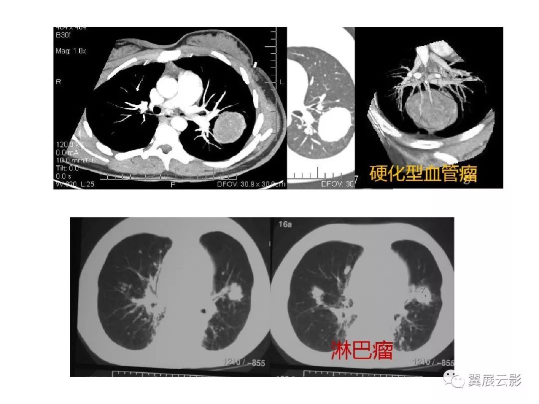 【收藏】肺癌影像表现综述