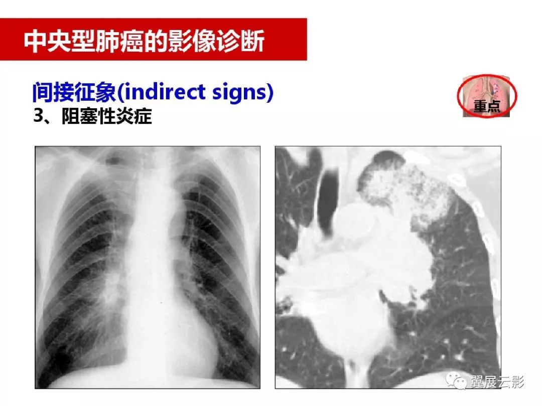 收藏肺癌影像表现综述