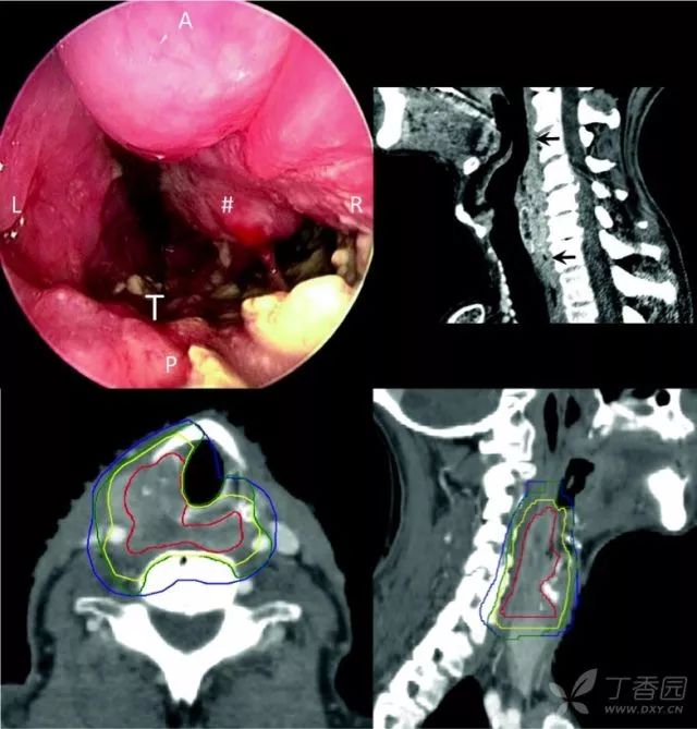 喉,下咽,口咽和口腔原发肿瘤临床靶区 (ctv-p) 勾画