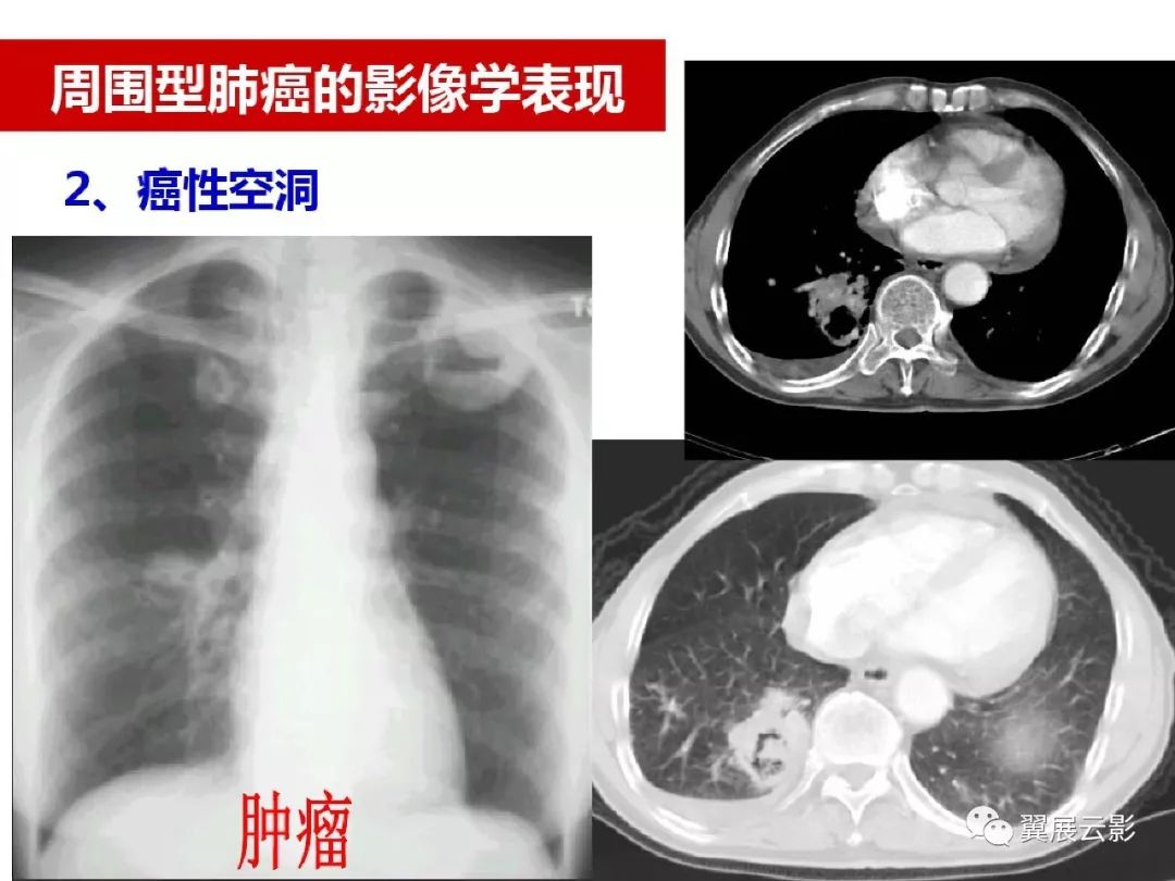 【收藏】肺癌影像表现综述