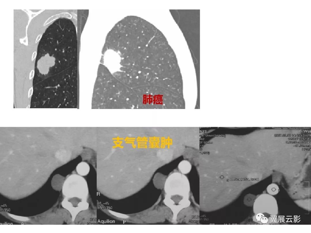 【收藏】肺癌影像表现综述