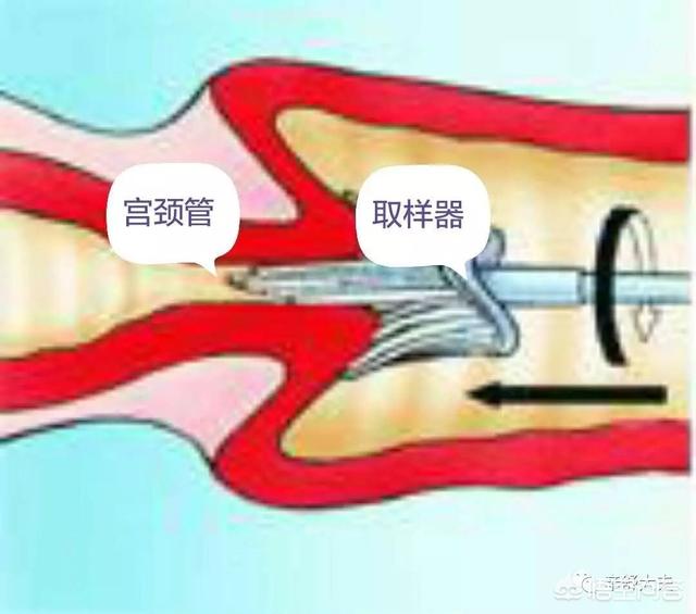 tct正常一年后宫颈癌是怎么回事呢