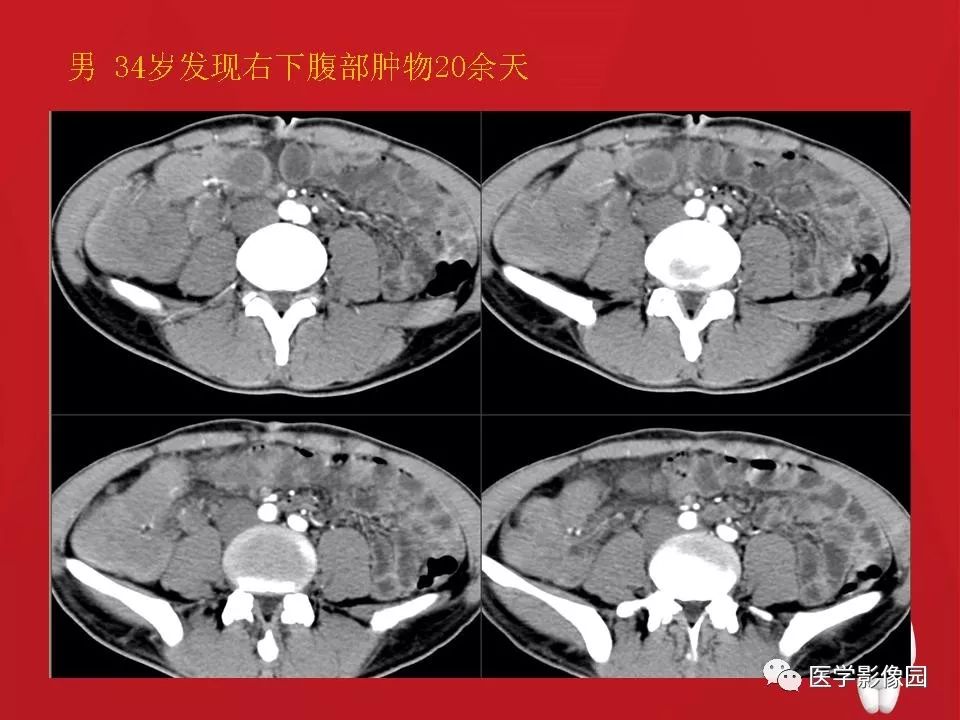 肠套叠的ct诊断