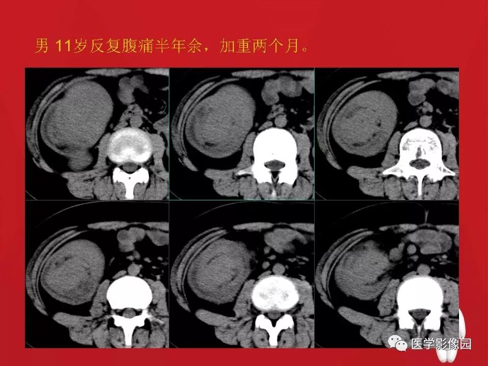 肠套叠的ct诊断