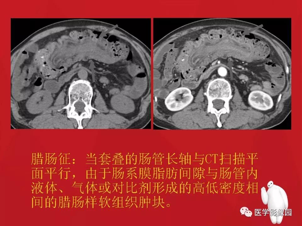 肠套叠的ct诊断