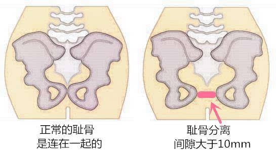 孕妇耻骨分离痛得受不了看看妈妈们怎么解决