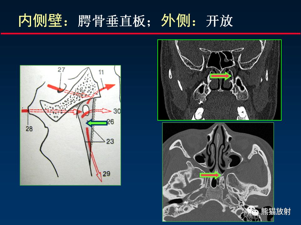 【柳澄讲坛】颅底重要ct解剖及其临床意义