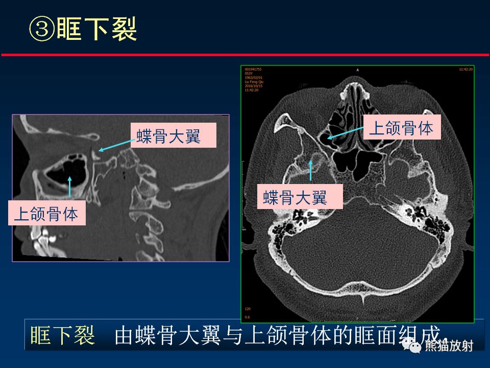 【柳澄讲坛】颅底重要ct解剖及其临床意义