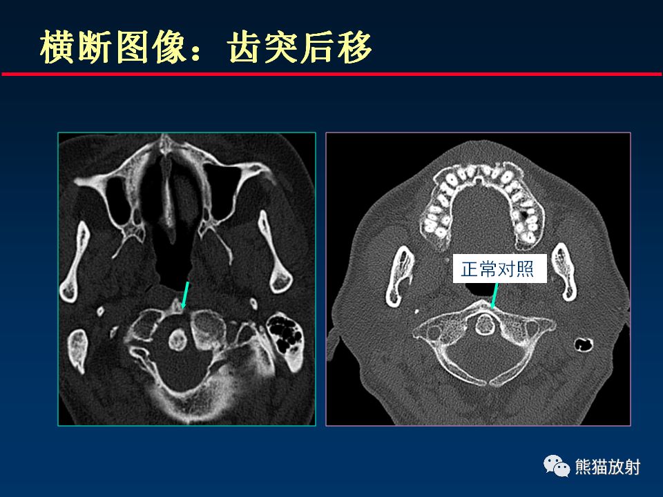 柳澄讲坛颅底重要ct解剖及其临床意义