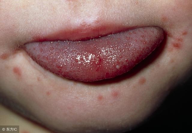 小儿手足口病是由病毒引起的以口腔,手足部位疱疹为特点的一种传染病.
