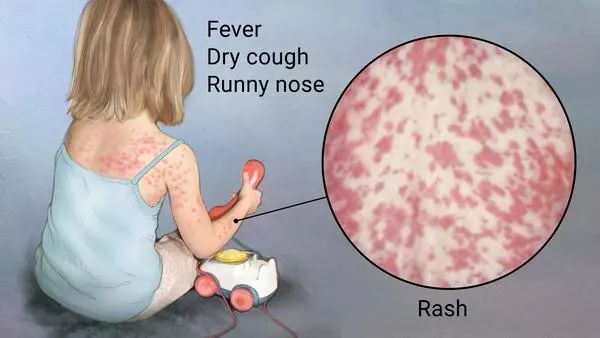 偶见皮肤荨麻疹,隐约斑疹或猩红热样皮疹,在出现典型皮疹时消失