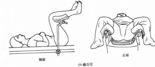 在这里,我们需要先花一点篇幅了解一下妇科检查时的体位—膀胱截石