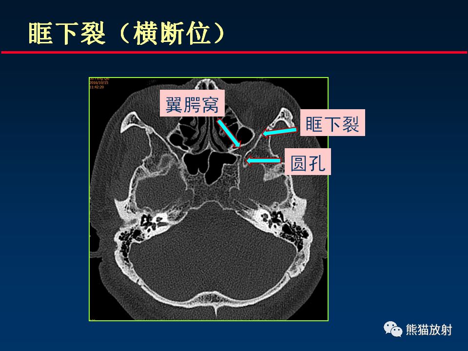 【柳澄讲坛】颅底重要ct解剖及其临床意义