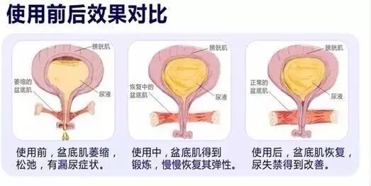 盆底松弛双生花——子宫脱垂&阴道壁膨出