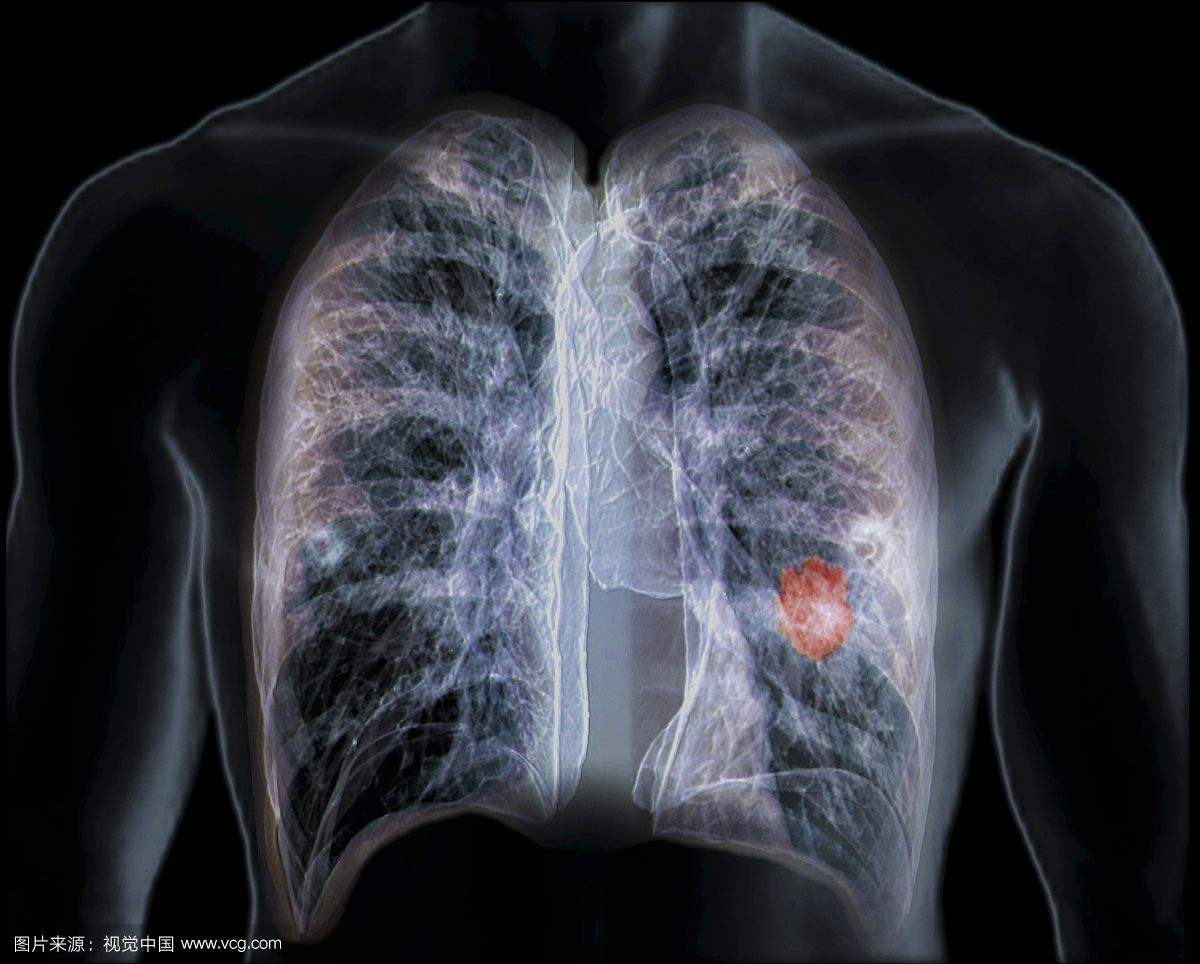 肺癌早期2大症狀！肺癌分期症狀、存活率、成因一次看 - 癌症問康健
