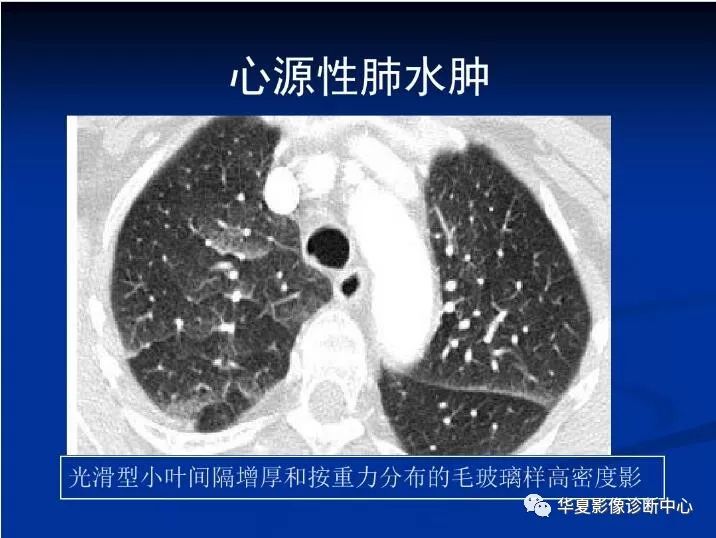 【影像基础】常见肺水肿的ct表现