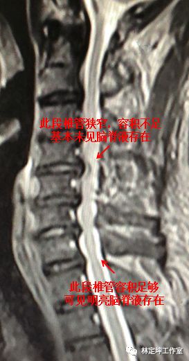 颈椎mri可见到张叔的颈椎管狭窄,容积不足,狭窄部分脑脊液缺乏