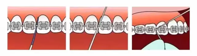 第一步:将牙线穿过弓丝与牙齿之间的间隙