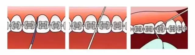 矫正如何正确刷牙牙套族必要看