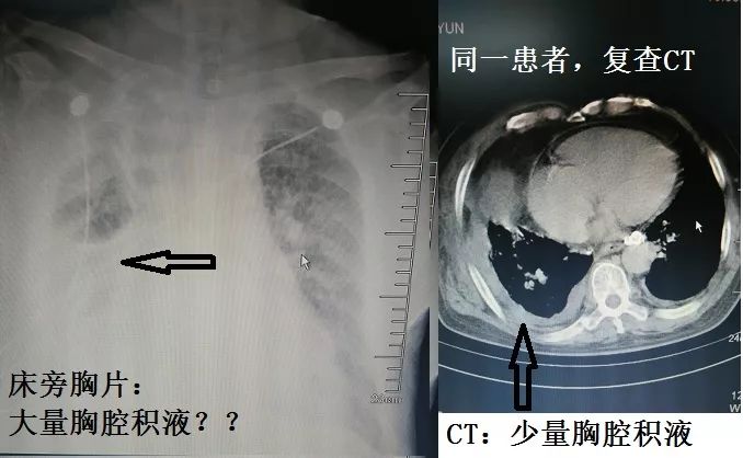 为什么要做ct不做b超,因为右边的患者就是胸片,b超都说是胸腔积液