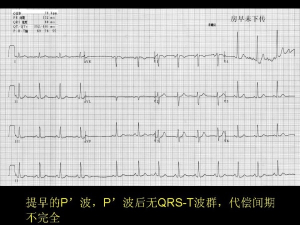 心电图学习第二弹,各类心脏疾病的心电图表现