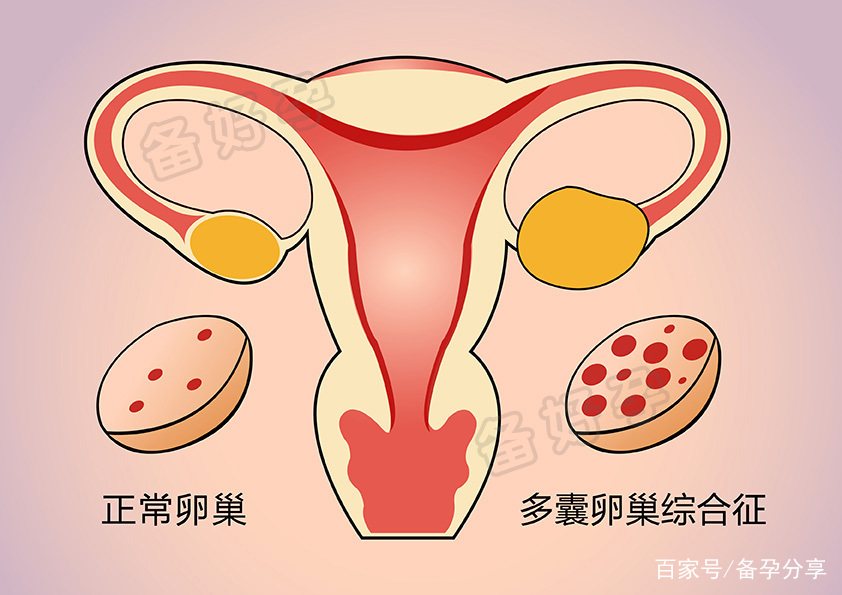 生化妊娠:刚怀孕就来月经,说明夫妻存在哪些问